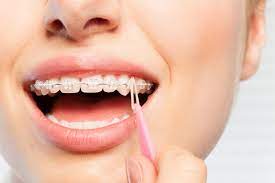 In other cases, after removing your 1st rubber band, you may need another variety. How To Put Rubber Bands On Braces Premier Orthodontics