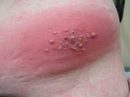 Image result for infected tick bite