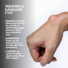 These growths tend to get bigger (and can cause increasing discomfort). Ganglion Cysts Information Florida Orthopaedic Institute
