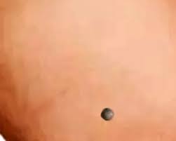 Image result for Blue Nevus