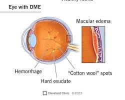 Image of Macular edema