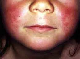 Image result for Scarlet Fever