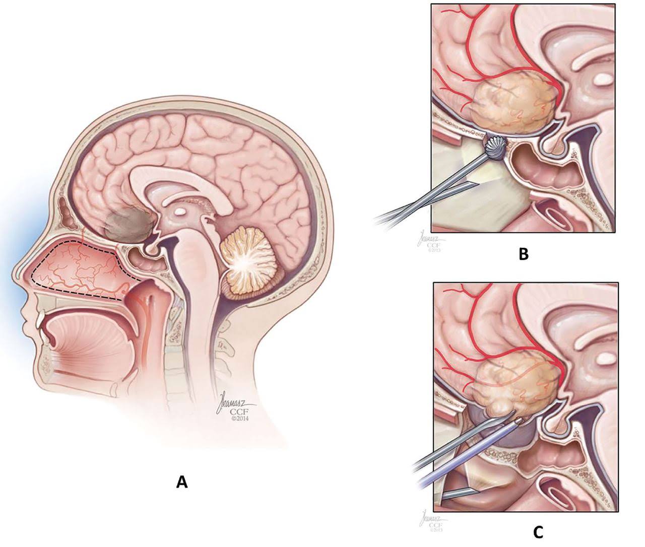 Endo Neurosurgery product image