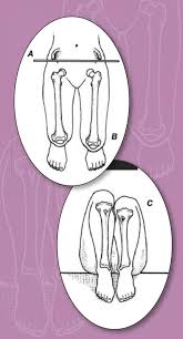 Image result for Functional Leg Length Discrepancy