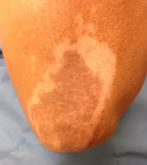 According to the skin cancer foundation, dermatologists have been investigating the link can tattoos give you cancer? Speaking Of Vitiligo Should Someone With Vitiligo Get A Tattoo