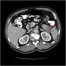 Pancreatic Cancer Presenting As Colonic Disease A Rare Case Report Sciencedirect