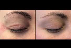 If the swollen upper eyelid do not respond to any of the conventional treatment methods and starts to worsen then it is best to see the eye doctor immediately. Condition Categories Eyelid Dermatitis Fixmyskin