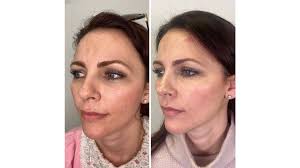 NCTF 135 HA vs Profhilo