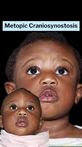 Metopic Craniosynostosis Surgery: Reshaping a 1-Year-Old's Forehead