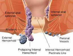 Hemorrhoid - Wikipedia
