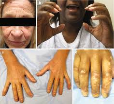 Image result for Systemic Sclerosis