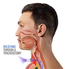 Image result for Tracheostomy