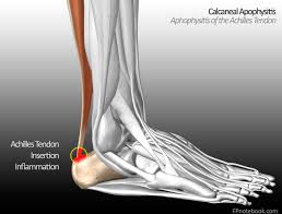 Image result for Calcaneal Apophysitis