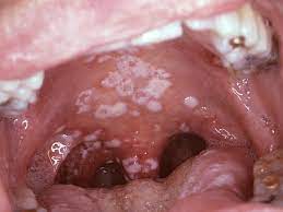 Red Spots On Roof Of Mouth Causes And Other Symptoms