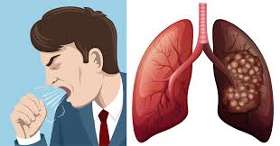 Among nonsmokers, women get lung cancer more frequently than men. 8 Early Warning Signs Of Lung Cancer You Should Know David Avocado Wolfe