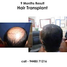 Hair Transplant Result In 9 Months Stepping Into The New Life For You Call Us 94485 71216 Hair H Hair Transplant Cost Hair Transplant Fue Hair Transplant