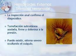 Es una complicación de las hemorroides simples, lo que provoca un cuadro agudo de intenso dolor. Patologia Anorectal Dra Susana G Umaa Moreno Medico