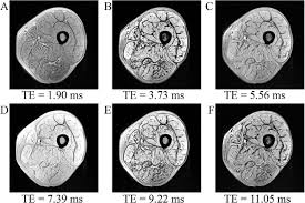 You may revoke your consent at any time once logged in, in your account settings. Evaluation Of 2 Point 3 Point And 6 Point Dixon Magnetic Resonance Imaging With Flexible Echo Timing For Muscle Fat Quantification European Journal Of Radiology