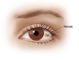 Comprendre le naevus (taches de rousseur sur les yeux) |  Système de santé de Saint-Luc