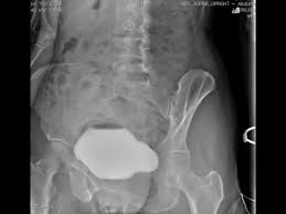 Image result for Voiding Cystourethrogram