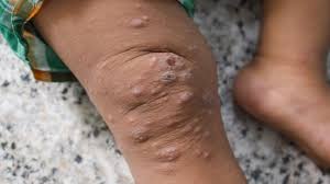 Image result for scabies transmission