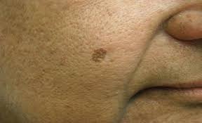 Unlike other types of lentigo, lentigo simplex isn't caused by skin damage. Lentigo Simplex Pictures Photos
