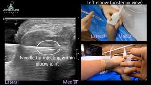 Image result for Elbow Joint Injection