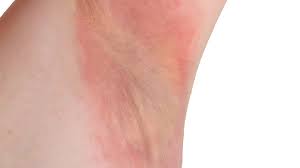 Image result for Erythrasma