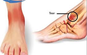 Grade 2 sprains usually take about two to three weeks to recover from. Anterior Tibiofibular Ligament Sprain Symptoms Diagnosis Treatment