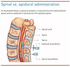 Image result for Intrapleural Anesthesia