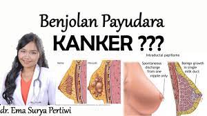Sakit dada sebelah kiri kerap dikaitkan dengan serangan jantung, padahal tidak selalu. 6 Jenis Benjolan Kanker Payudara Dan Non Kanker Dr Ema Surya P Youtube