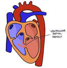 Image result for Ventricular Septal Defect