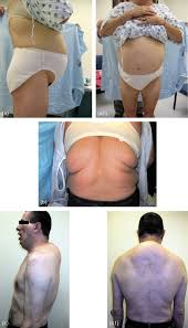 Image result for Lipodystrophy