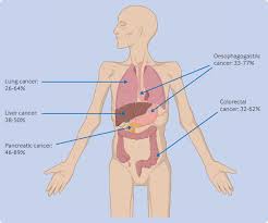 Image result for Cachexia in Cancer