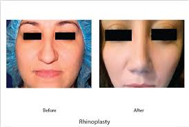 Plastic Surgery Orange County Los Angeles California Newport Beach Plastic Surgeons Pasadena Plastic Surgery Rhinoplasty Facial Plastic Surgery Nose Job