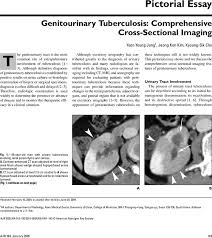 Image result for Genitourinary Tuberculosis