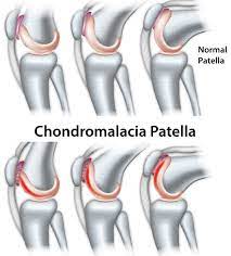 Chondromalacia Patella | Causes And Treatment | Sportnova Uk