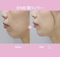 BYME【顎フィラー】で理想の横顔＆小顔へ | BYME整形外科