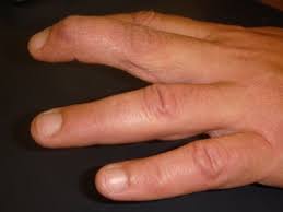 After the tendon is healed and the splint use is no longer needed. Mallet Finger Injury Melbourne Hand Surgery