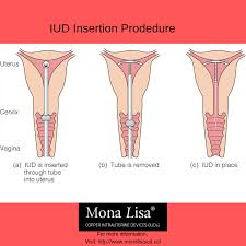 Pulls the insertion tube all the way out. Pin On Women S Health