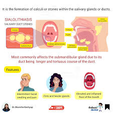 Image result for Sialolithiasis