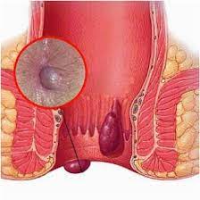 Όταν ένα αιμοφόρο αγγείο τραυματίζεται, το σώμα χρησιμοποιεί αιμοπετάλια (θρομβοκύτταρα). Aimorroides