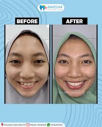 Gigi Berantakan bukan akhir dari segalanya, karena kamu bisa bisa kembali  cantik dengan perawatan ortho. Dengan gigi yang rapih kamu jadi lebih  percaya diri, dan pastinya bentuk muka kamu juga lebih simetris😍