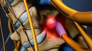 Pin On Neck Surgery