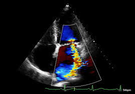 Maybe you would like to learn more about one of these? Echocardia Normwerte