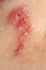 Was tun, wenn herpes genitalis kurz vor der entbindung ausbricht? Herpes Simplex Ansteckung Symptome Behandlung