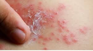 Image result for diaper dermatitis adult -children -infant -baby