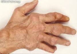 Image result for gout