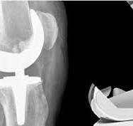 Prótesis postero-estabilizada: El componente femoral ...