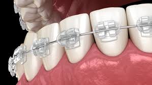 Rubber bands for braces are an integral part of your braces, and without them your braces won't work properly. Dental Cleaning Before Getting Braces Omega Dental Houston Tx